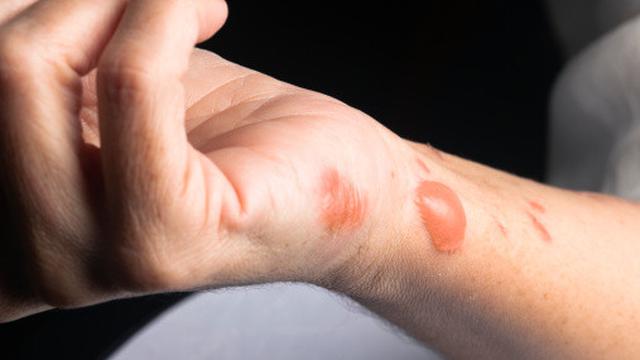 Memecahkan lepuhan luka bakar dengan sengaja dapat menyebabkan infeksi.